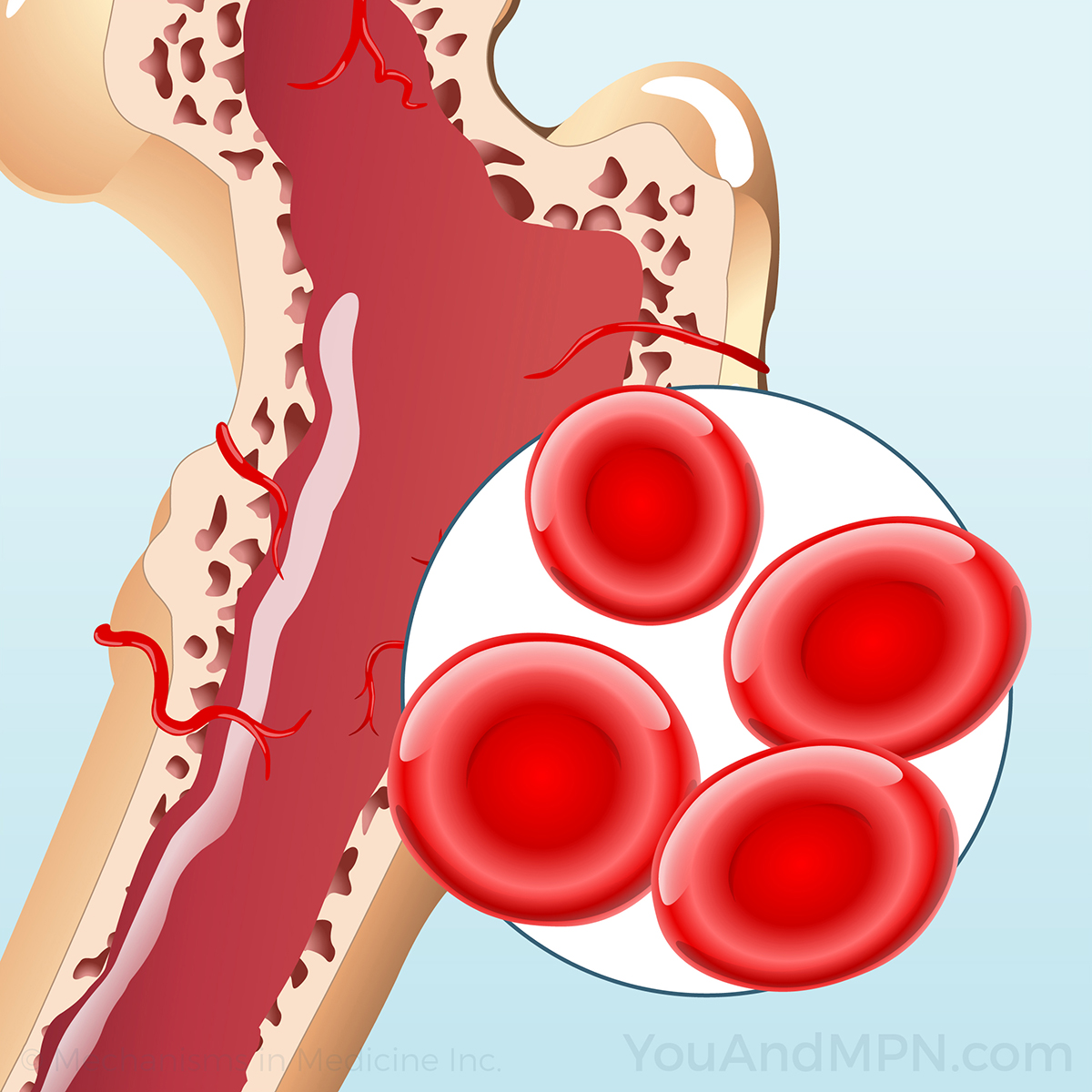 Polycythemia Vera (PV)